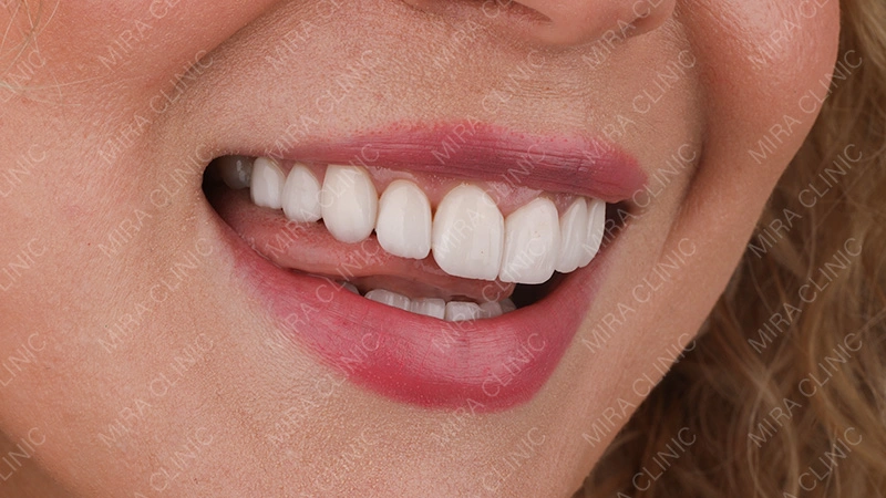 Veneers before and after overview
